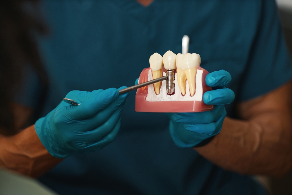 Explaining the Dental Implant Procedure – Dental Implants in Palm Springs A close-up of a dental professional demonstrating the dental implant structure using a tooth model, showcasing education and expertise in dental implants in Palm Springs – Dental Implants in Palm Springs