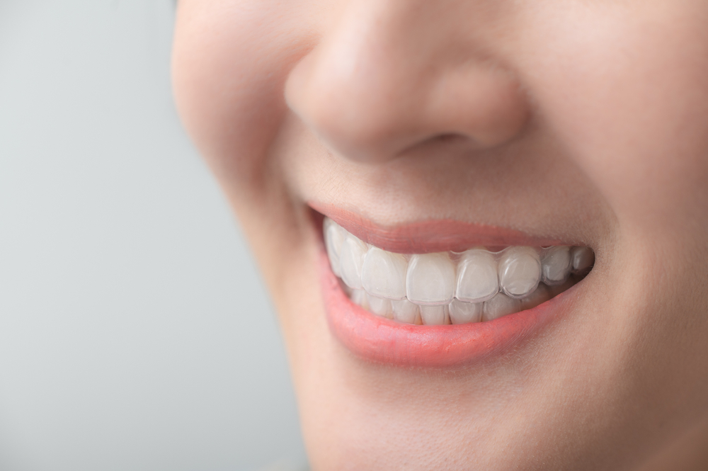 A detailed close-up of a healthy, aligned smile demonstrating the discreet and effective results of Invisalign treatment – Invisalign in Palm Desert